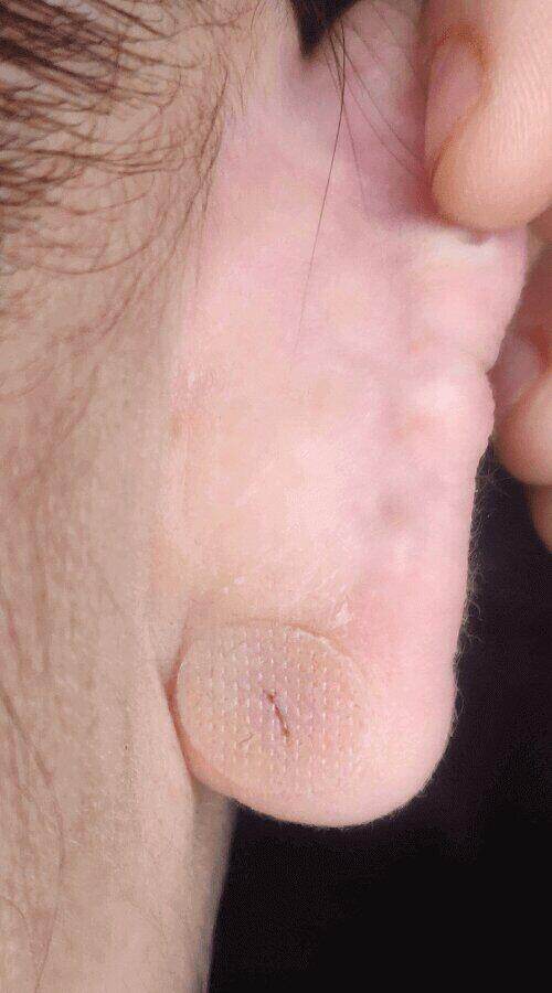 lobe support patches